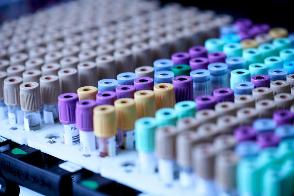 ankylosing spondylitis tests